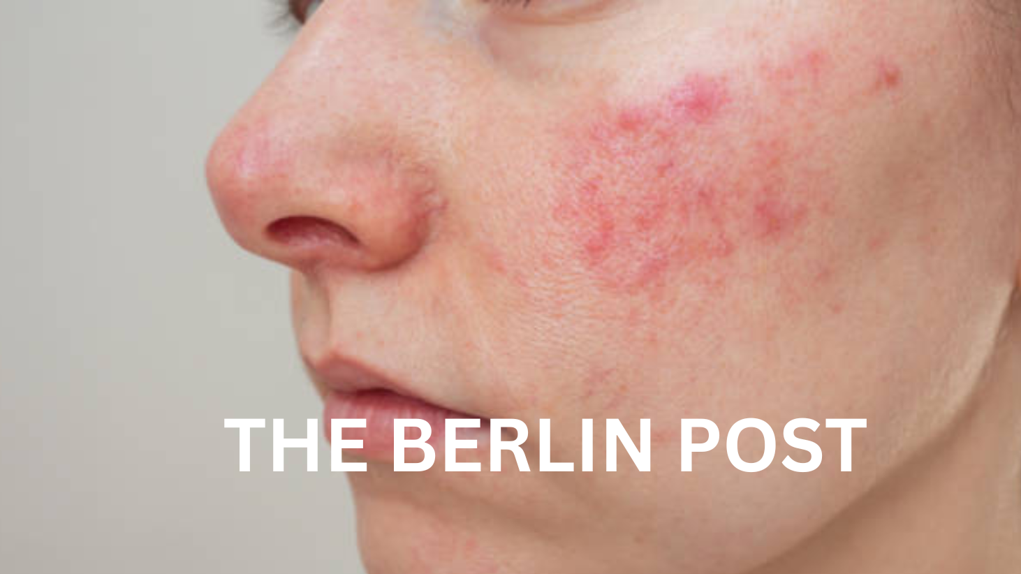 Schuppenflechte im Gesicht Ursachen, Symptome, Behandlungsmöglichkeiten und Tipps für die Hautpflege (1)